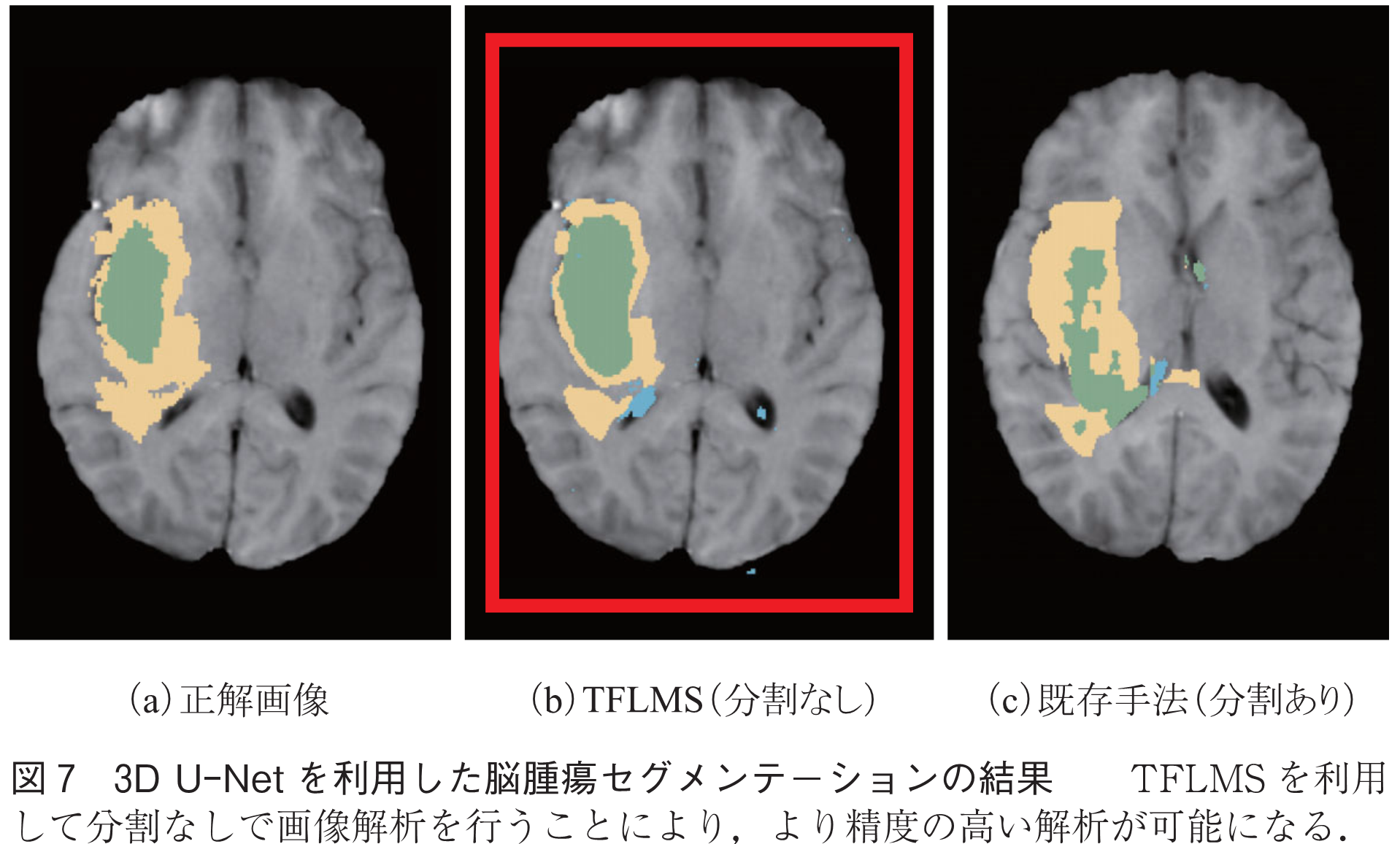 図7　3D U-Netを利用した脳腫瘍セグメンテーションの結果