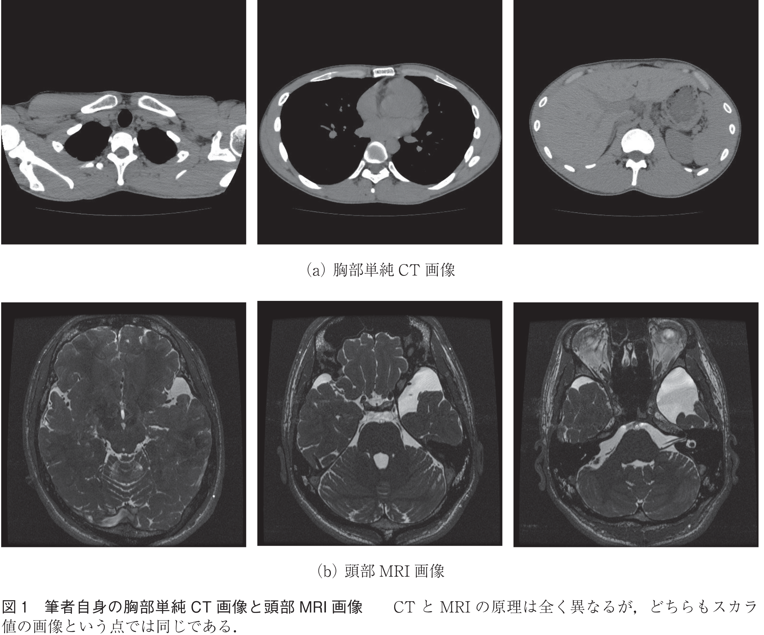 図1　筆者自身の胸部単純CT画像と頭部MRI画像　　CTとMRIの原理は全く異なるが，どちらもスカラ値の画像という点では同じである．