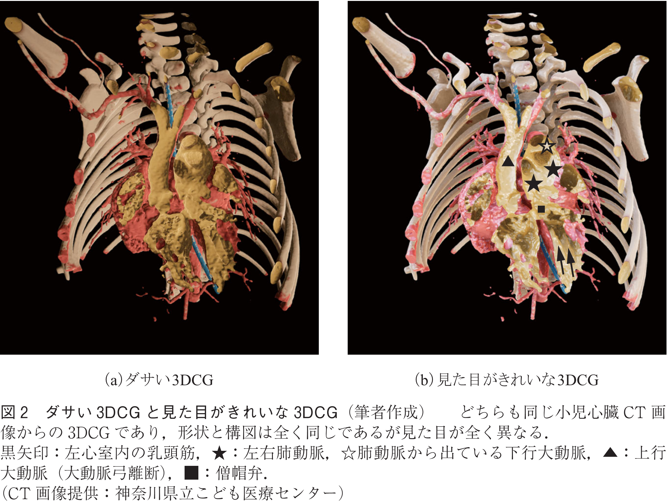 図2　ダサい3DCGと見た目がきれいな3DCG（筆者作成）　　どちらも同じ小児心臓CT画像からの3DCGであり，形状と構図は全く同じであるが見た目が全く異なる．